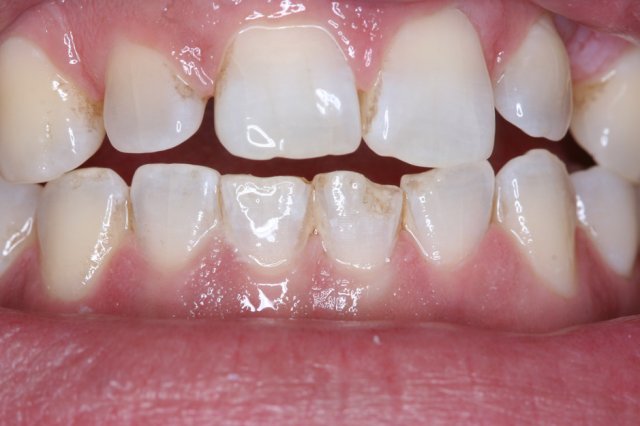 Lower Chipped Tooth Before